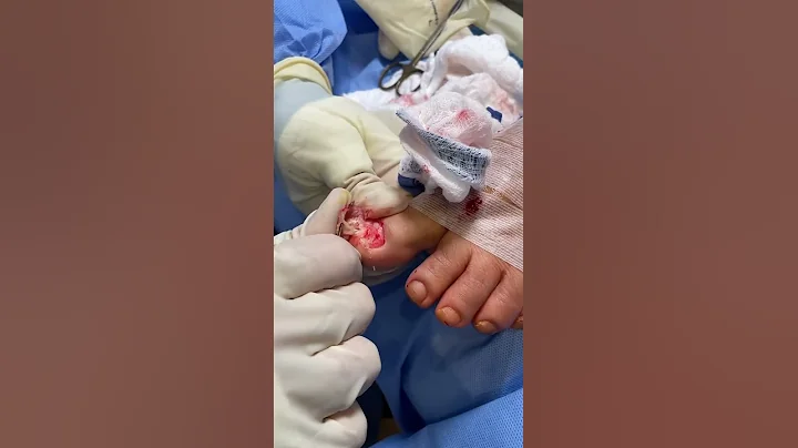 Watch Dr. K's SHOCKING Toe Nail Fungus Removal! 😱