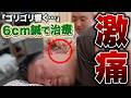 【首痛】耐え続けて30年…|6cm鍼で救済【鍼灸】