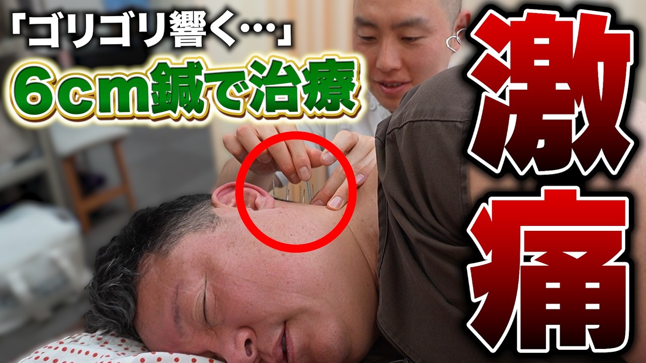 調気鍼法 講演集 Neck pain] Enduring it for 30 years | Relief with a 6cm needle