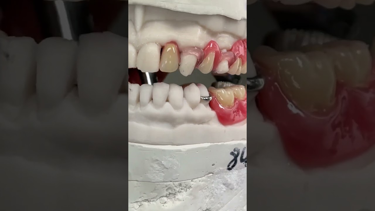 Two different types of clasps