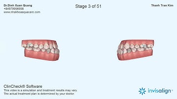 Video mô phỏng quá trình  điều trị Invisalign Niềng Răng Trong suốt