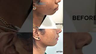 Correct your gummy smile without surgery and regain your confidence | Gummy smile