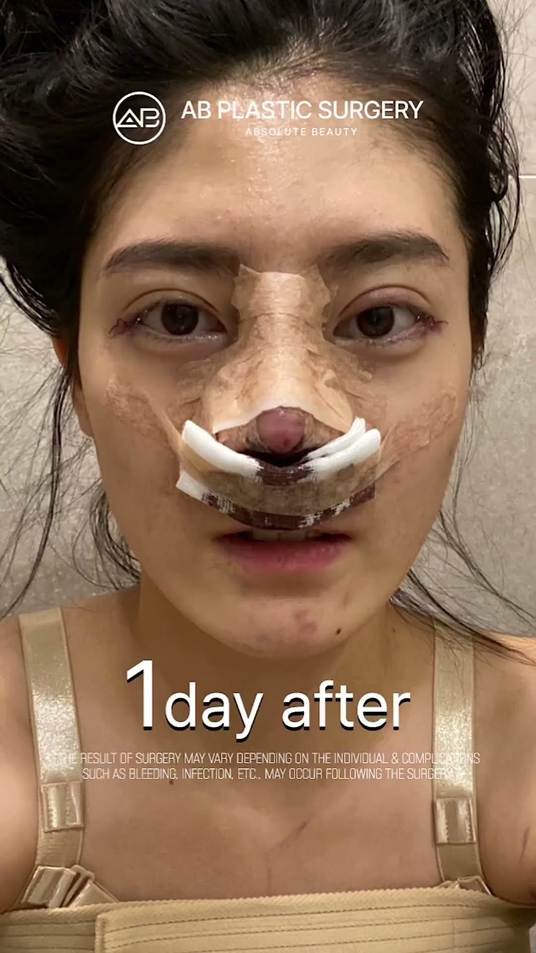 [Plastic surgery in Korea] Non-incisional Ptosis Correction & Rhinoplasty [Wide Nose & Short Nose]
