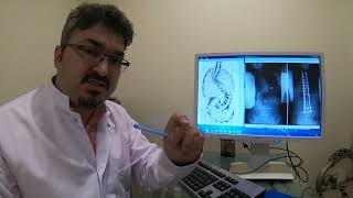 How long does a scoliosis operation take?