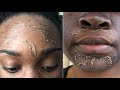 I GOT A CHEMICAL PEEL FOR HYPERPIGMENTATION | BEFORE & AFTER RESULTS