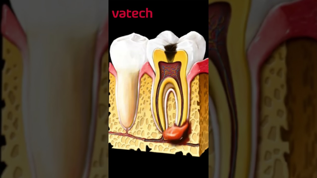 Что будет если не лечить кариес? #стоматология #vatech #shorts
