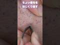 ちょい埋毛との戦い#tweezers #毛抜き