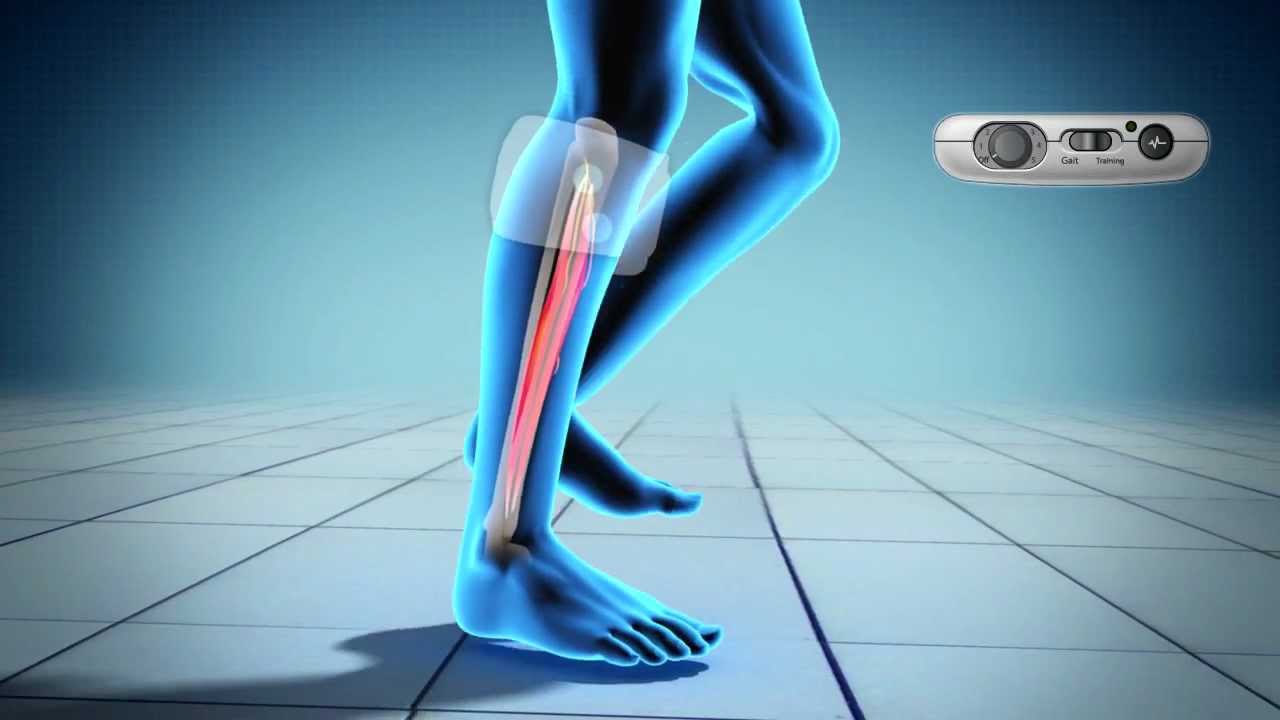 XFT2001 Foot Drop Device YouTube