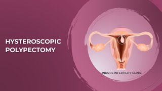 Removal of Uterine Polyp | Hysteroscopic Polypectomy (How is it done) | Removal of Polyp in Uterus
