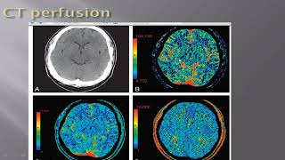 14- CT perfusion role in infarction