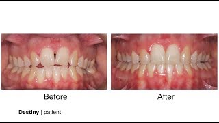 Yang Orthodontics - Patient Testimonial after Braces
