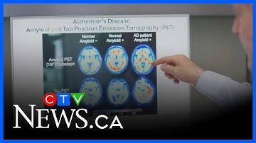 Health Canada approves dementia medication Lecanemab