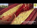 About Your Heart Attack (Hindi) - CIMS Hospital