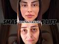 The best lift still looks like your own face. #facelift #naturalresults