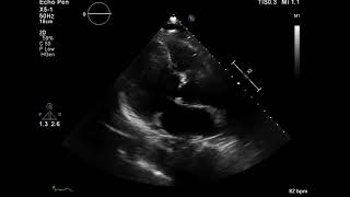 Normal LV Systolic Function Without Hyperdynamic LV
