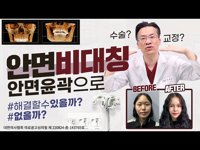 안면비대칭 안면윤곽으로 해결할수있을까? 없을까? #안면윤곽