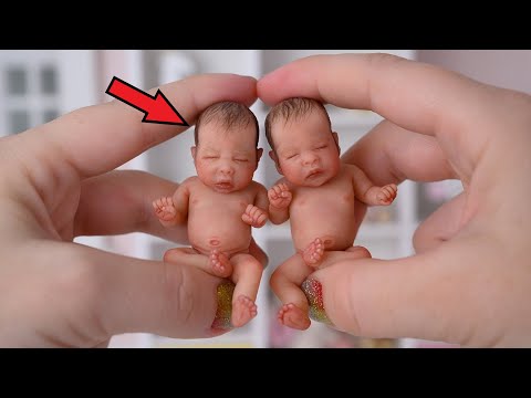 Помните самых маленьких близнецов в мире? Вы не поверите, что с ними случилось...