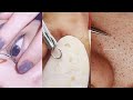 9 minutes of top asmr pimple popping