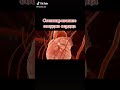 СТЕНТИРОВАНИЕ сосудов СЕРДЦА Shorts стентирование стент операция