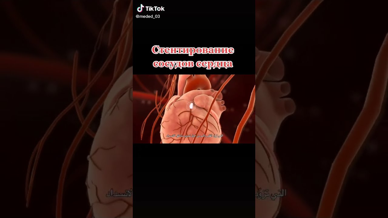 СТЕНТИРОВАНИЕ сосудов СЕРДЦА #shorts #стентирование #стент #операция