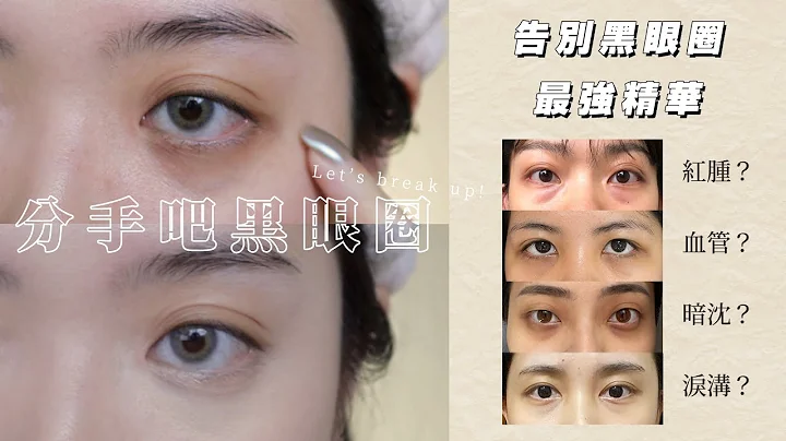 告别黑眼圈2.0！你知道自己是哪种类型的黑眼圈吗？ // 心蒂急诊室S3｜CindyH - 天天要闻