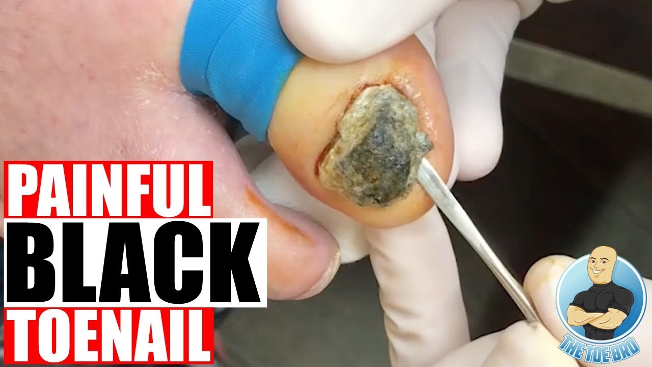 Black Toenail: Causes, Treatment, and Prevention Tips : r/FeetFirstClinic