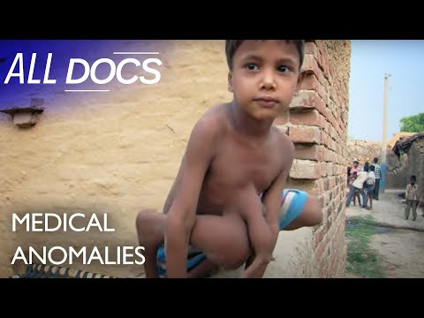 Video: Indian Doctors Have Safely Separated From The 7-year-old Boy His Twin Parasite - Alternative View