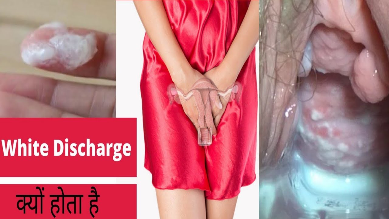 mahila me white discharge kyu hota hai aur kab hota hai | white discharge early pregnancy - YouTube