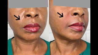 How to get Rid of Smile/Laugh Lines. nasolabial folds with Dermal fillers @flawlessskinbyabbymedspa