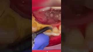DIY PLAQUE AND TARTAR REMOVAL FROM TEETH