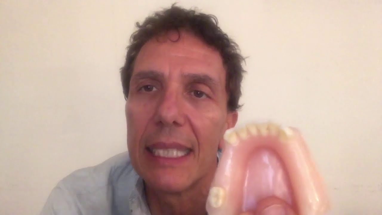 Cosa fare quando mancano tanti denti?