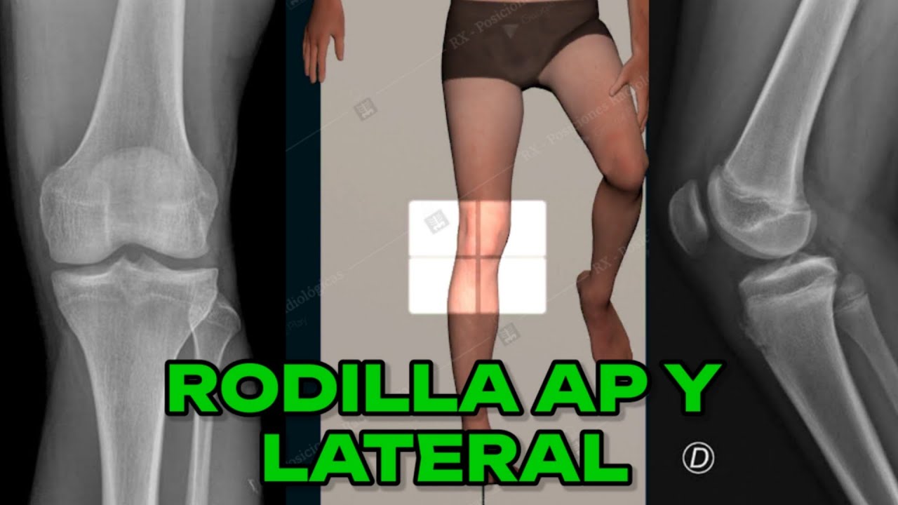 Rotula Axial Rx Radiografia De Rodilla 600x997