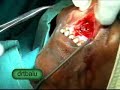 Nasolabial Cyst Being Excised