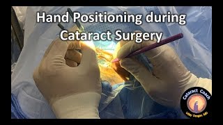 Hand Position during Cataract Surgery is critical!