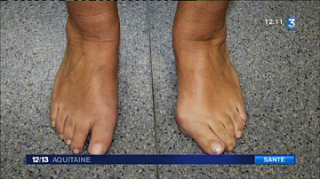 Pourquoi les pieds se déforment ?