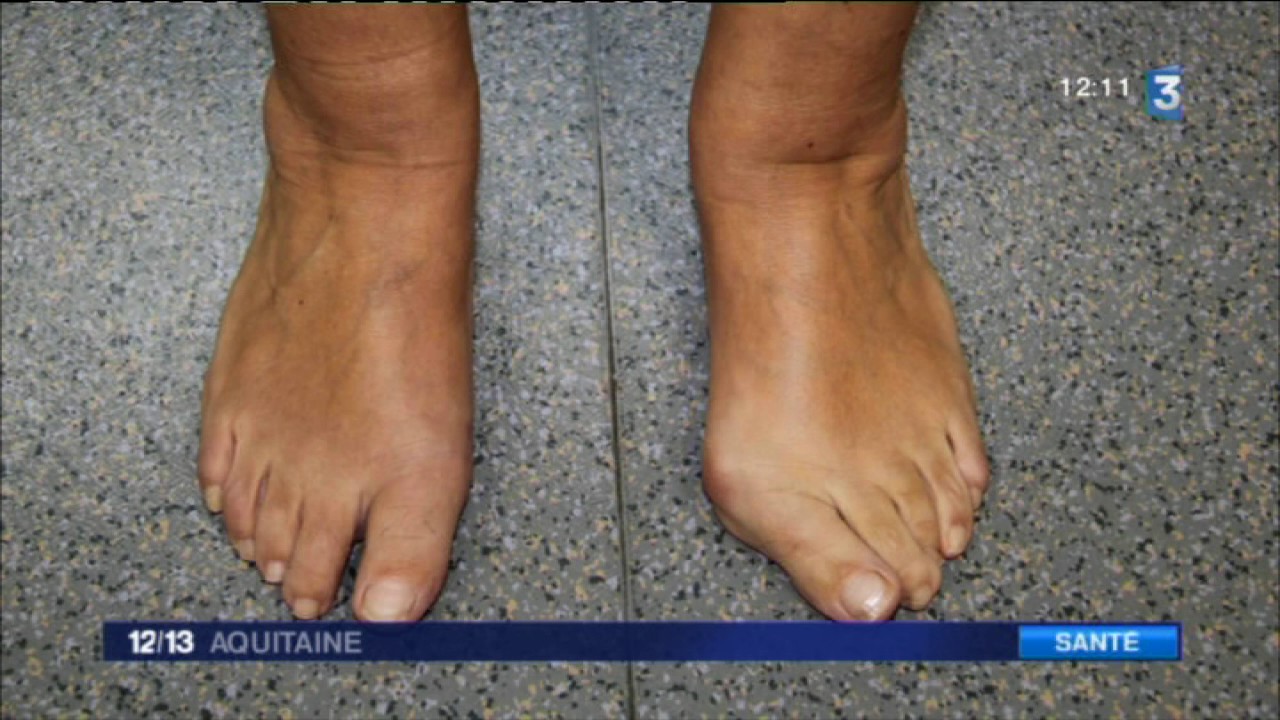 Sante Comment Soigner Un Hallux Valgus Ou Oignon Du Pied Youtube