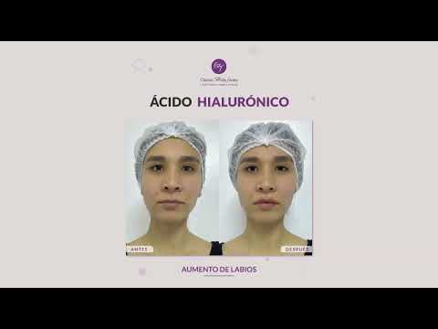 Aumento de labios con Ácido Hialurónico I Clínica Bellaforma