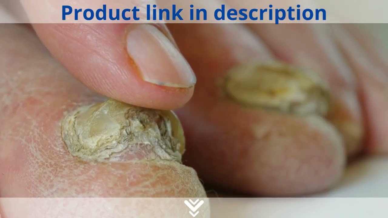 Kerassentials Fungus Review – Is It A Scam?