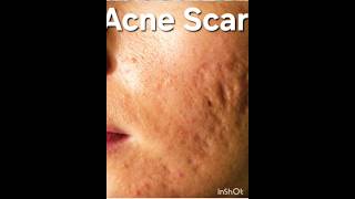 Acne Scar Treatment #acne #acnescar #acnetreatment #acnefighter #drirfanclinics
