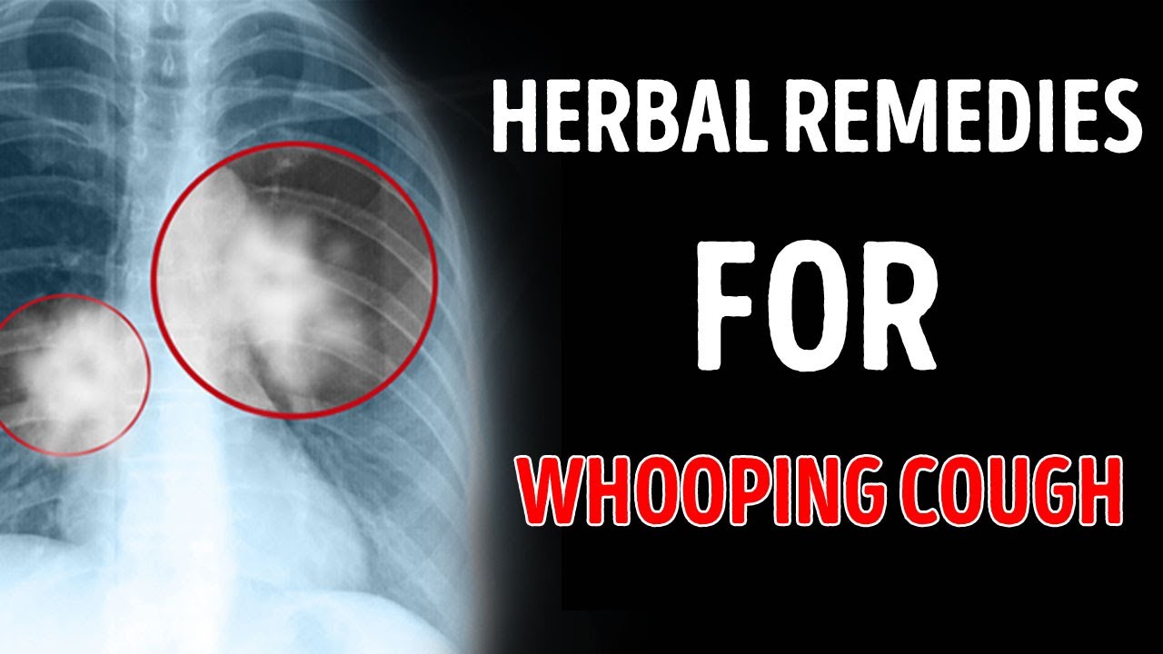 Whooping cough home remedies for whooping cough herbal remedies