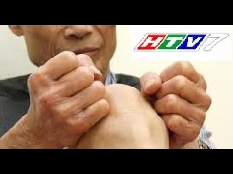 Video Đau nhức xương khớp toàn thân | Triệu chứng, nguyên... - youtube