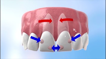 Discover how Invisalign works