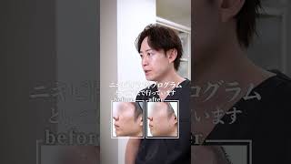 クレーター治療に年齢は関係ありません（30代男性）│ニキビ跡治療