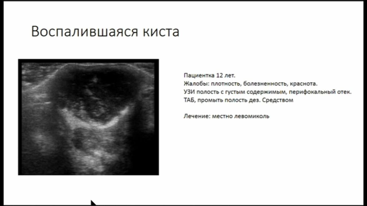 Киста в груди у женщин чем опасна