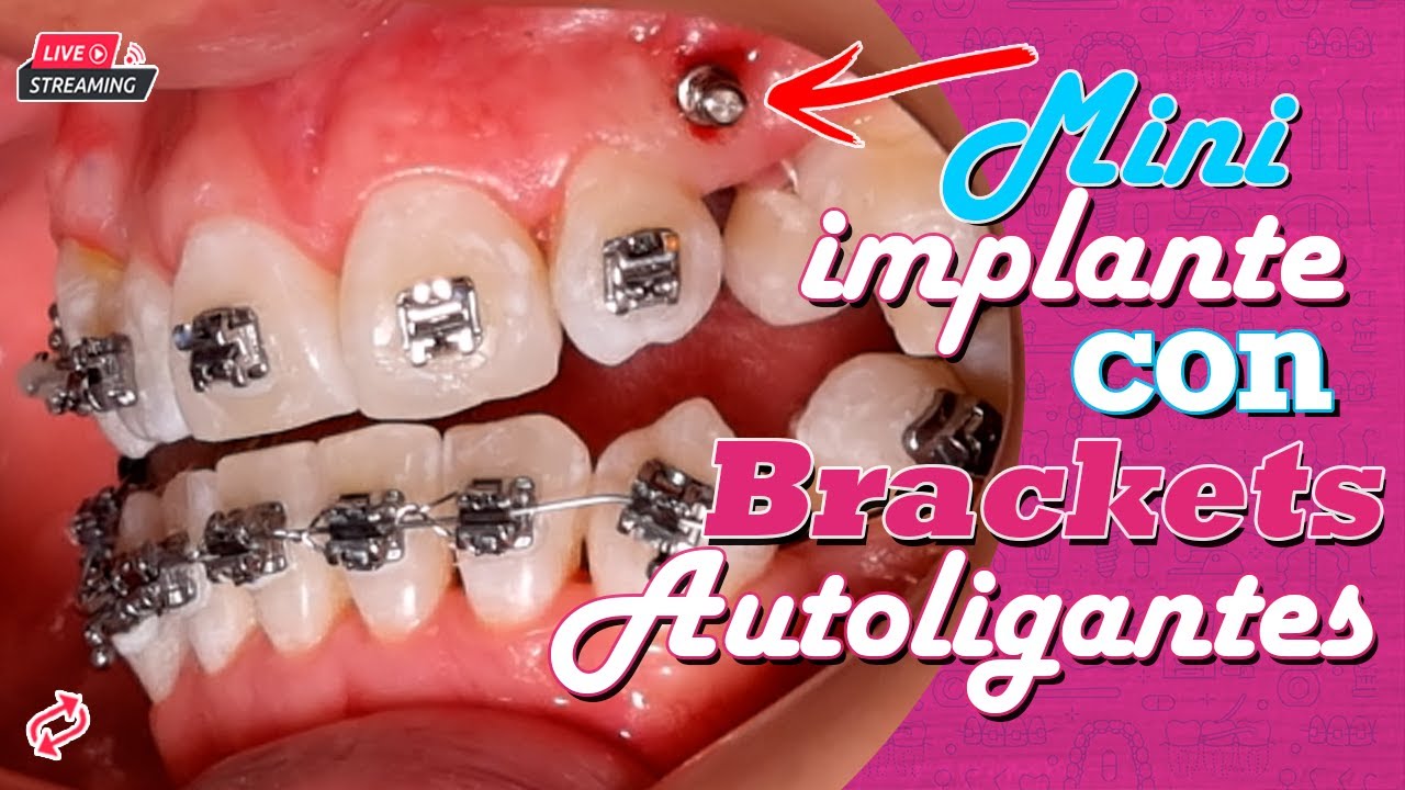 🔴POV BRACKETS autoligantes para RAICES CORTAS Brackets por SEGUNDA