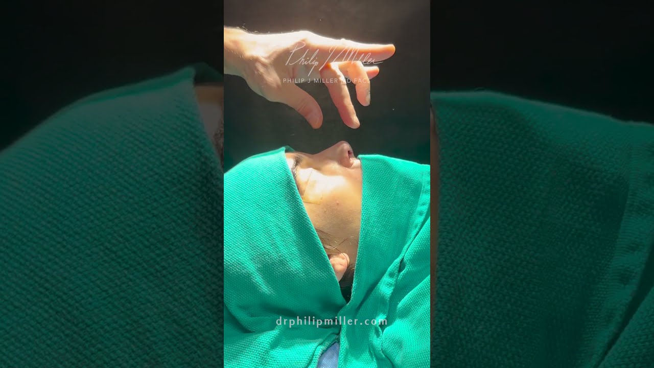 Immediate Tip Plasty Results Revealed!