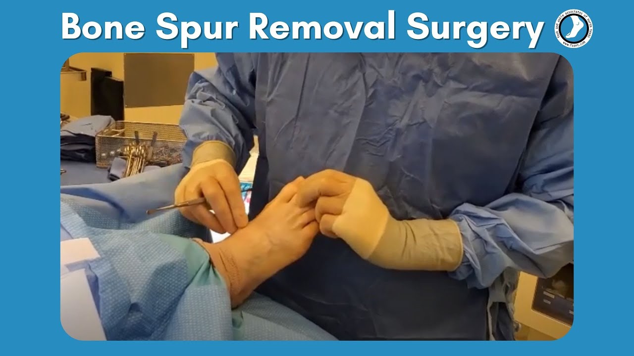 What is the Recovery Time for Heel Spur Surgery?