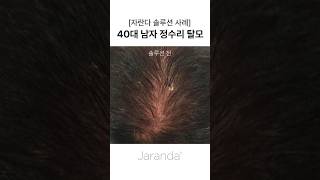 [자란다 솔루션 사례] 40대 남자 정수리 탈모 #정수리탈모
