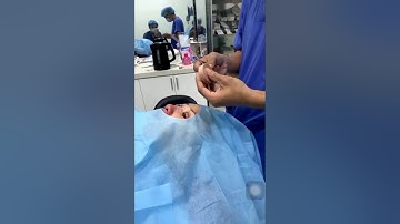 Combo nâng mũi bán cấu trúc + thu gọn cánh mũi + cắt mí mắt vừa xong - Bs Nguyễn Văn Hưng - Dr Lee