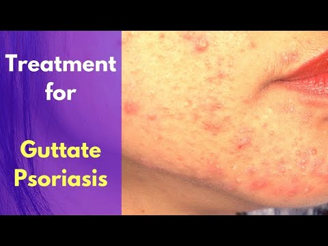 Video: Psoriasis Op Het Hele Lichaam, Vulgaris, Seborroïsche Psoriasis, Guttata En Palmoplantaire Psoriasis